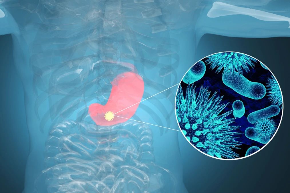 肿瘤标记物CA72-4：“胃”，你还好吗？